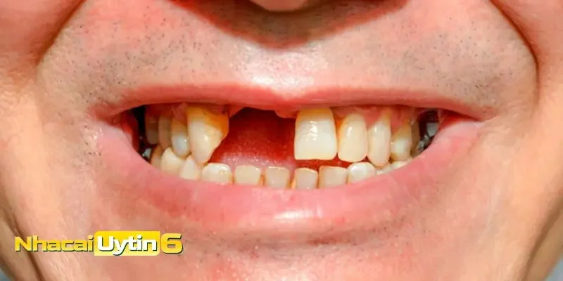 Ngủ thấy rụng răng không chảy máu